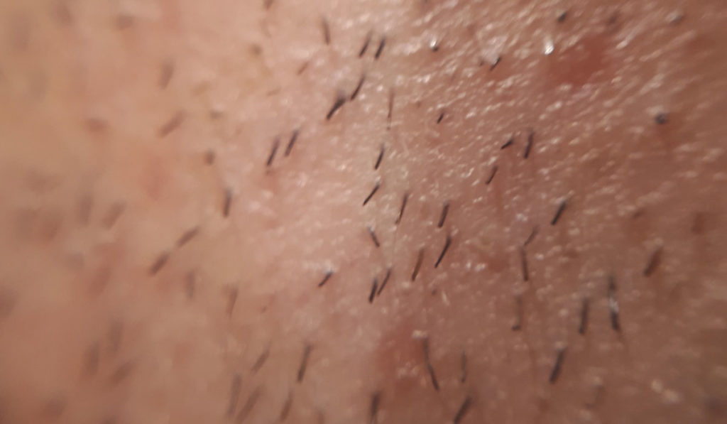 What are ingrown hairs