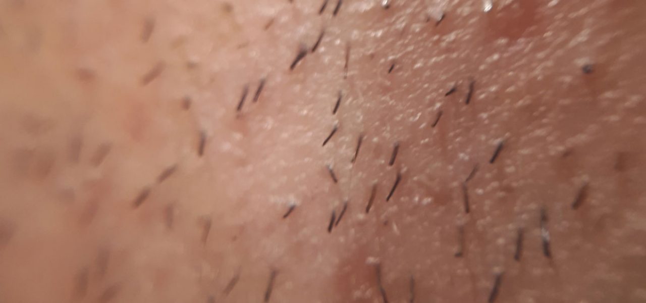 What Are Ingrown Hairs And How To Avoid Them - Pure Shave
